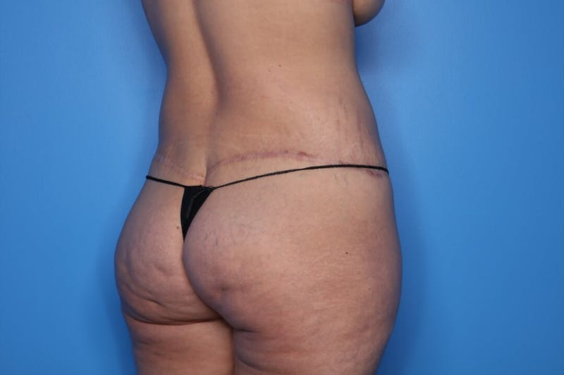 Body Lift Before & After Gallery - Patient 128454 - Image 6
