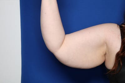 Arm Lift Before & After Gallery - Patient 398392 - Image 1