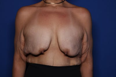 Body Lift Before & After Gallery - Patient 417176 - Image 1