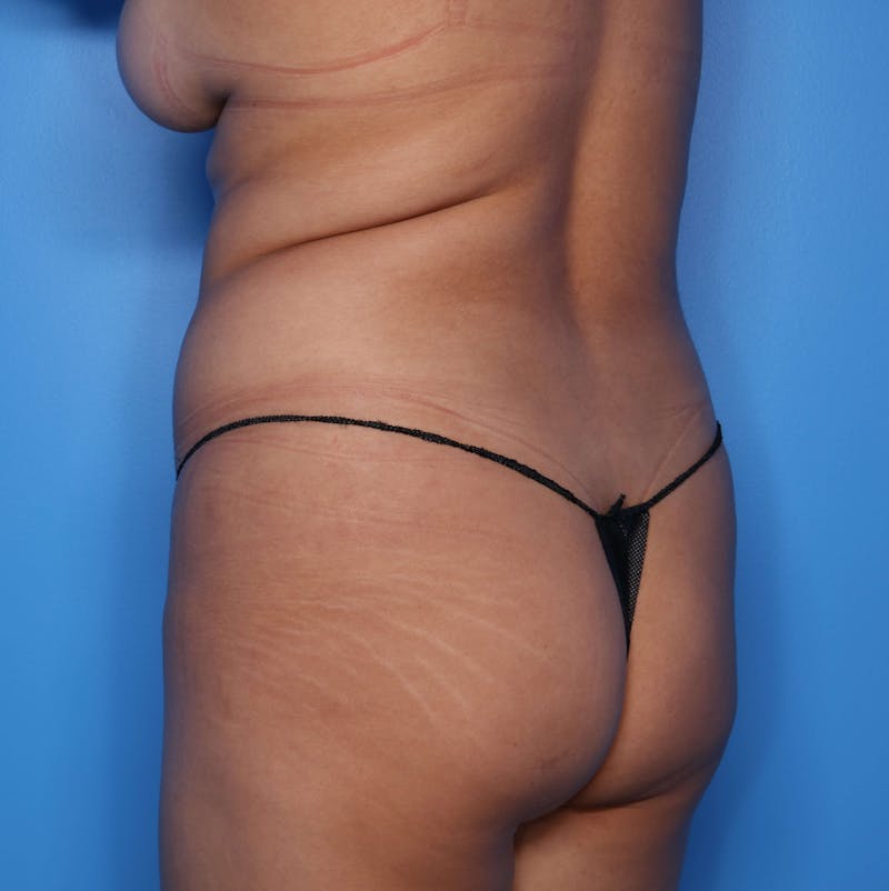 BodyTite™ Before & After Gallery - Patient 640260 - Image 3