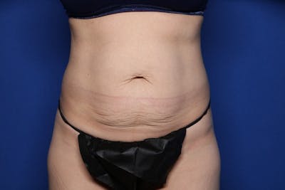 Tummy Tuck Before & After Gallery - Patient 417841 - Image 1