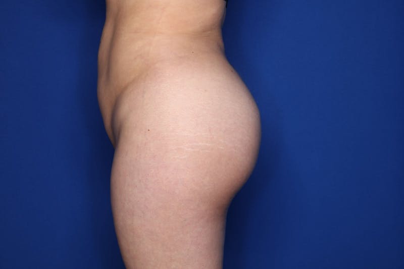 Brazilian Butt Lift Before & After Gallery - Patient 389407 - Image 8