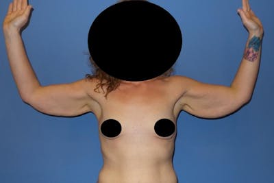 Arm Lift Before & After Gallery - Patient 403840 - Image 1