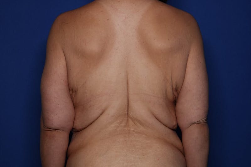 Body Lift Before & After Gallery - Patient 417176 - Image 5
