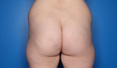 Brazilian Butt Lift Before & After Gallery - Patient 104195 - Image 1