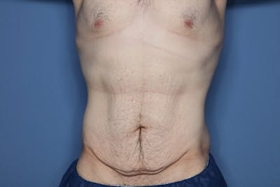 Body Lift Before & After Gallery - Patient 852011 - Image 1
