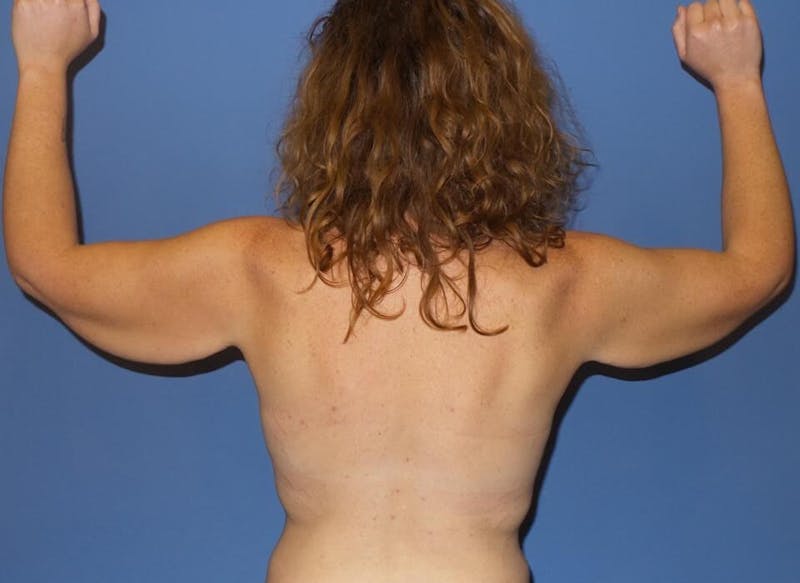 Arm Lift Before & After Gallery - Patient 403840 - Image 3