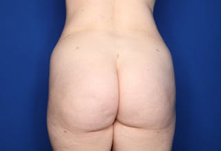 Brazilian Butt Lift Before & After Gallery - Patient 104195 - Image 4