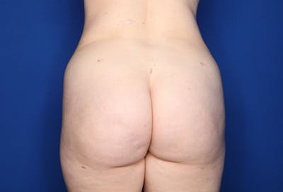 Brazilian Butt Lift Before & After Gallery - Patient 104195 - Image 2