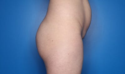Brazilian Butt Lift Before & After Gallery - Patient 104195 - Image 1