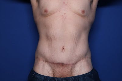 Body Lift Before & After Gallery - Patient 852011 - Image 2