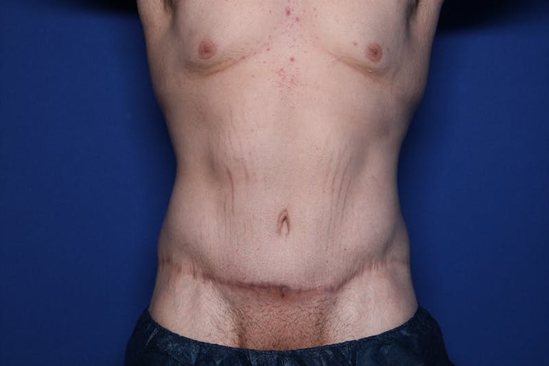Body Lift Before & After Gallery - Patient 852011 - Image 2