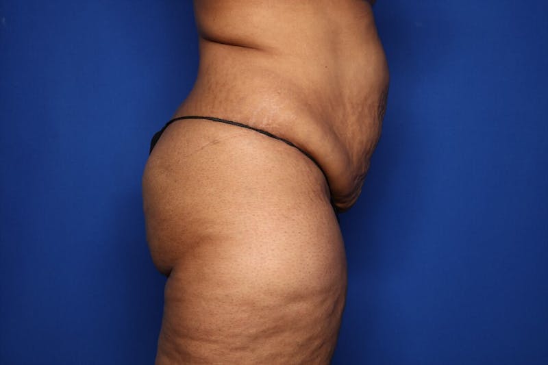 Tummy Tuck Before & After Gallery - Patient 411496 - Image 3