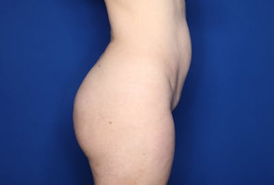 Brazilian Butt Lift Before & After Gallery - Patient 104195 - Image 2