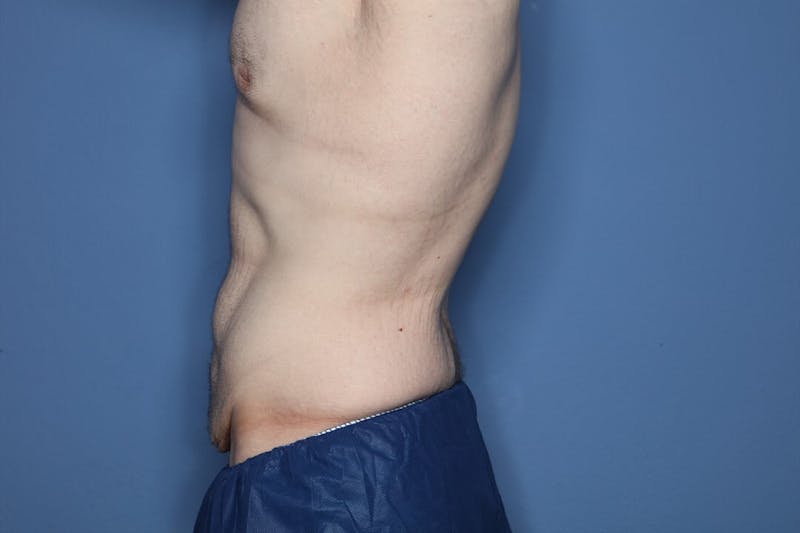 Body Lift Before & After Gallery - Patient 852011 - Image 3