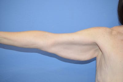 Arm Lift Before & After Gallery - Patient 254204 - Image 1