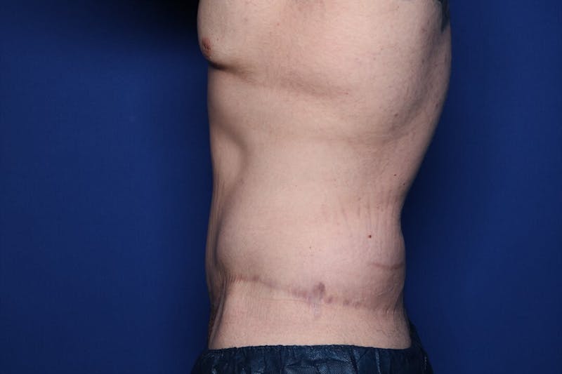 Body Lift Before & After Gallery - Patient 852011 - Image 4