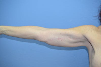 Arm Lift Before & After Gallery - Patient 254204 - Image 2