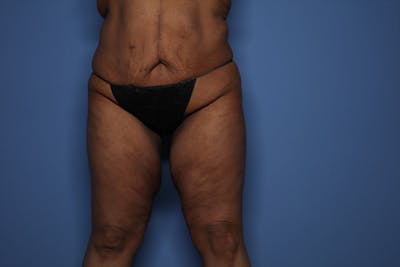 Thigh Lift Before & After Gallery - Patient 375823 - Image 1