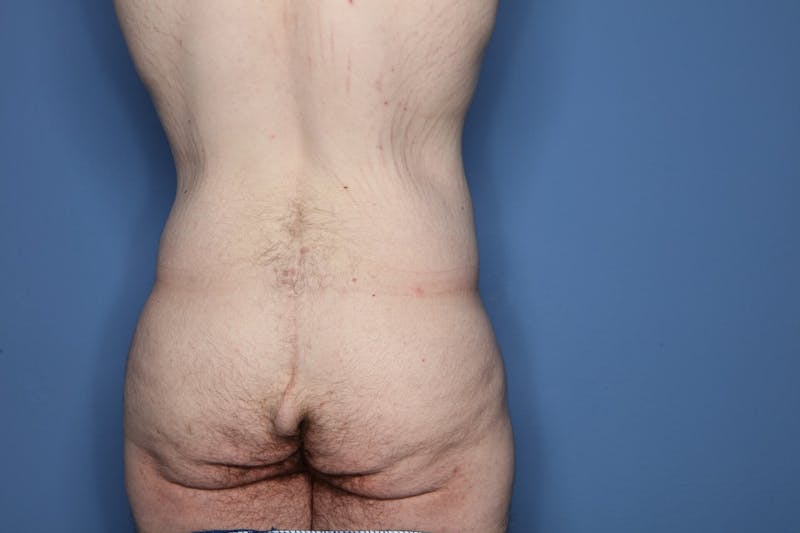 Body Lift Before & After Gallery - Patient 852011 - Image 5