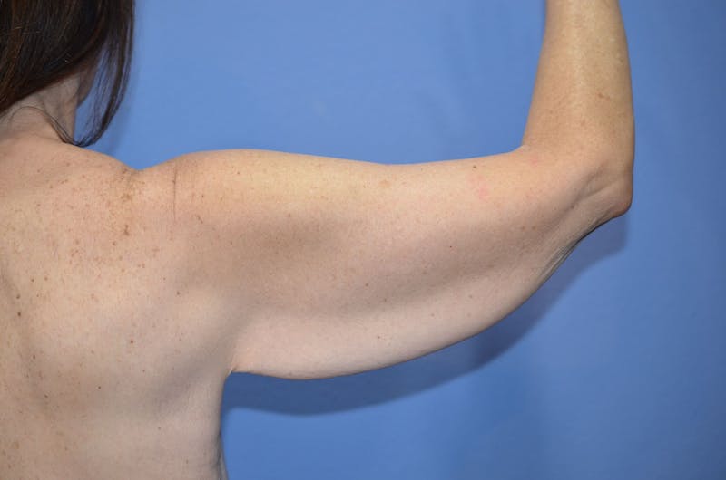 Arm Lift Before & After Gallery - Patient 254204 - Image 3