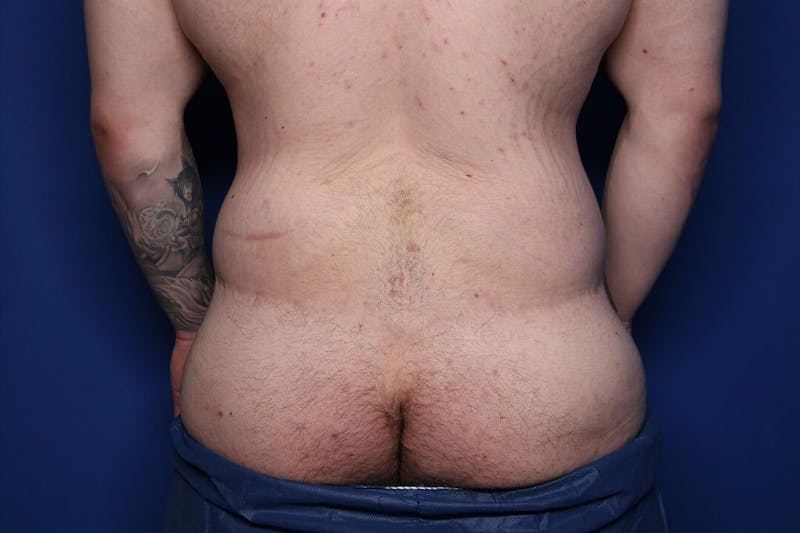 Body Lift Before & After Gallery - Patient 852011 - Image 6