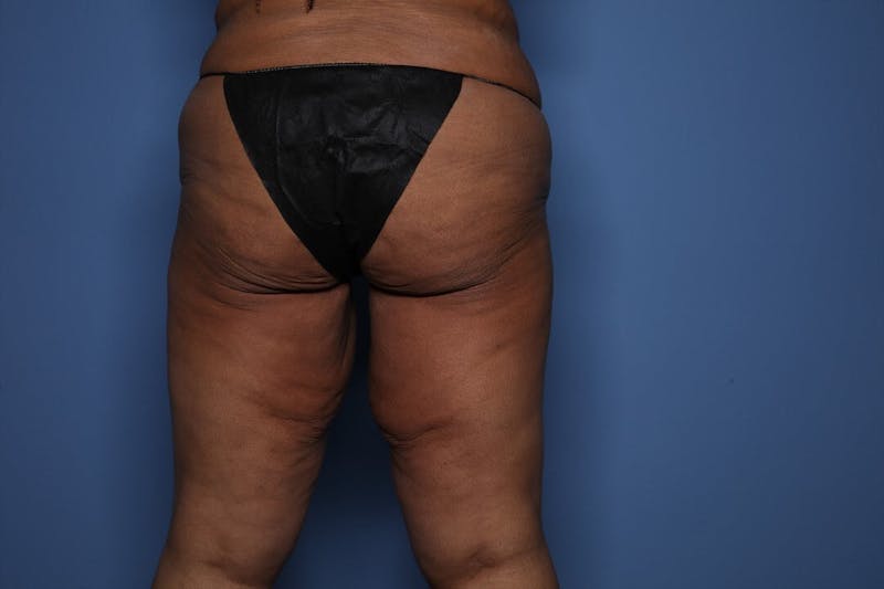 Thigh Lift Before & After Gallery - Patient 375823 - Image 3