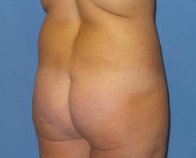Brazilian Butt Lift Before & After Gallery - Patient 820888 - Image 1