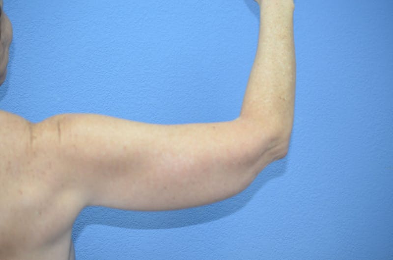 Arm Lift Before & After Gallery - Patient 254204 - Image 4