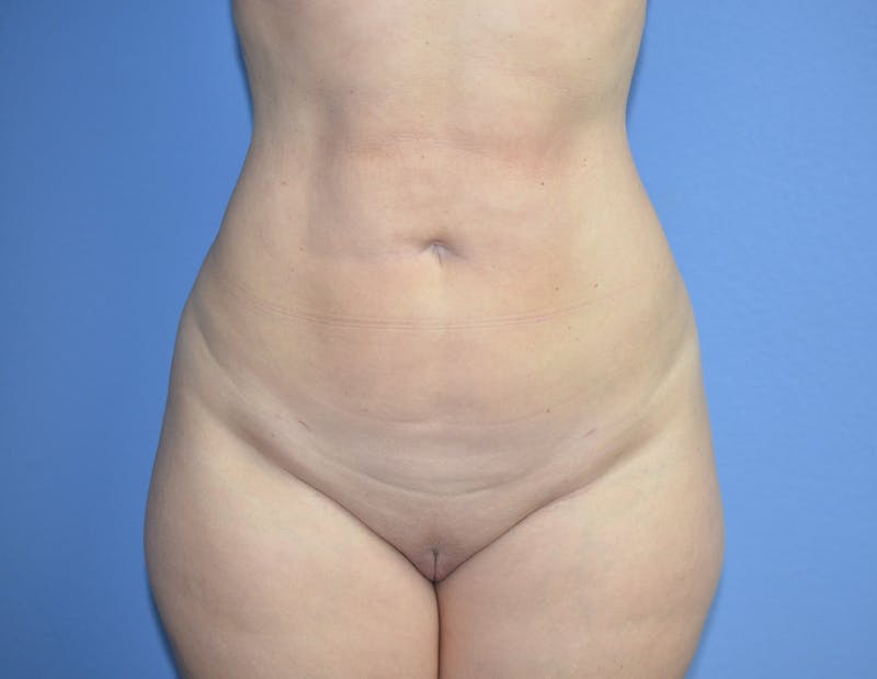 BodyTite™ Before and After Before & After Gallery - Patient 406925 - Image 2