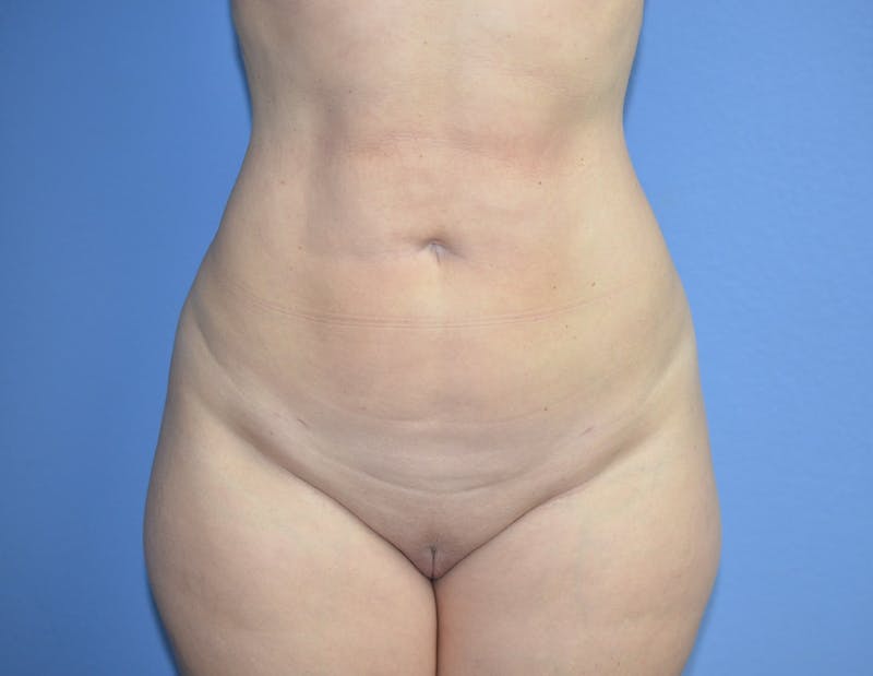 BodyTite™ Before & After Gallery - Patient 406925 - Image 2