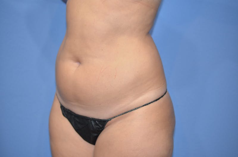 BodyTite™ Before & After Gallery - Patient 406925 - Image 3
