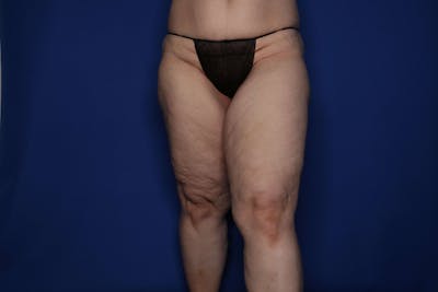 Thigh Lift Before & After Gallery - Patient 307919 - Image 1