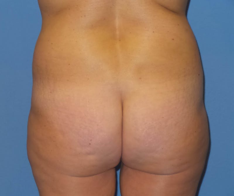 Brazilian Butt Lift Before & After Gallery - Patient 820888 - Image 3