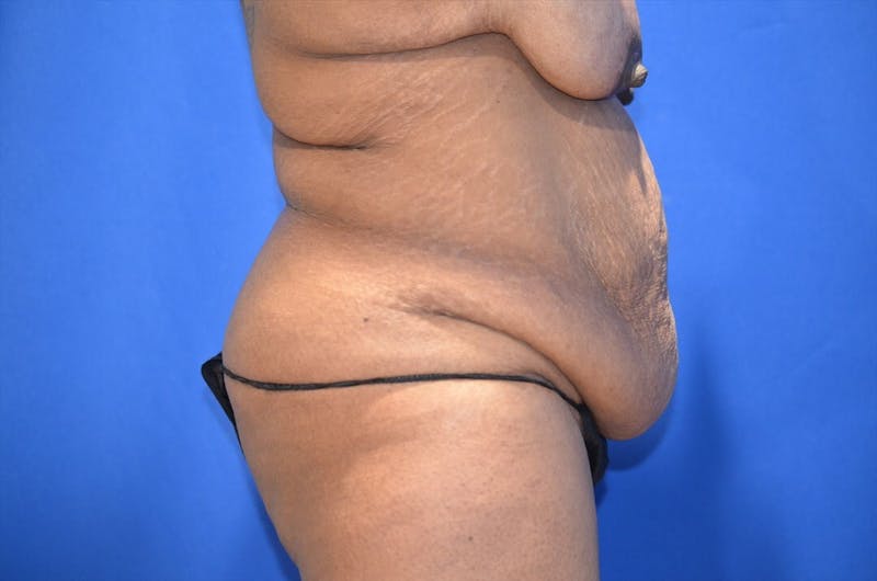 Body Lift Before & After Gallery - Patient 146807 - Image 3