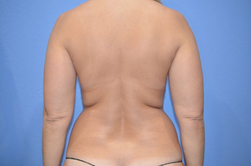 BodyTite™ Before and After Before & After Gallery - Patient 406925 - Image 5