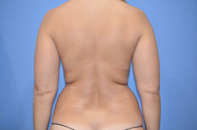 BodyTite™ Before & After Gallery - Patient 406925 - Image 5