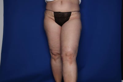 Thigh Lift Before & After Gallery - Patient 307919 - Image 2