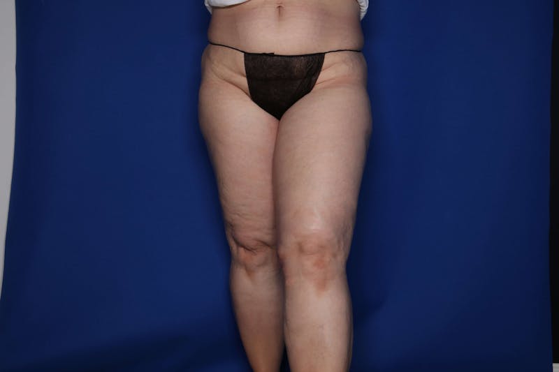 Thigh Lift Before & After Gallery - Patient 307919 - Image 2