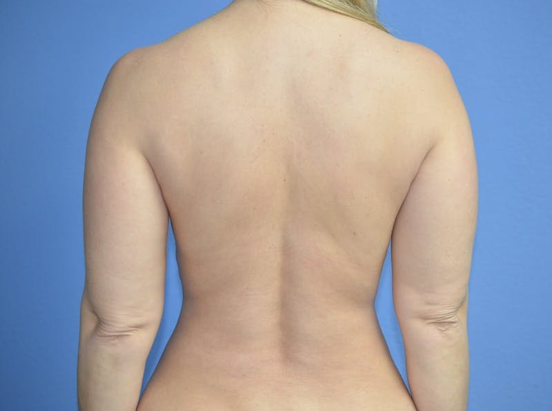 BodyTite™ Before and After Before & After Gallery - Patient 406925 - Image 6