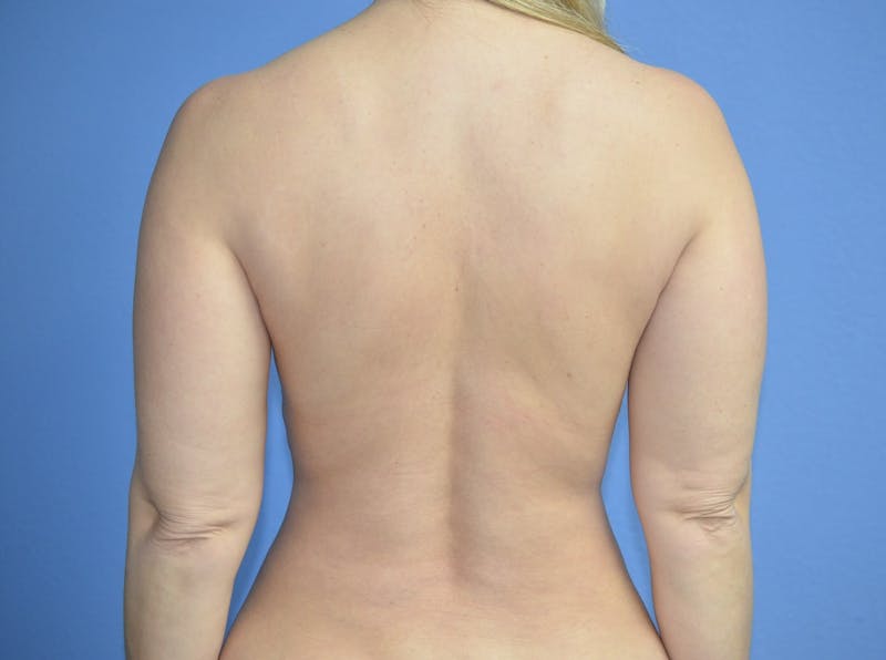 BodyTite™ Before & After Gallery - Patient 406925 - Image 6