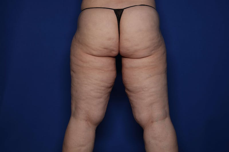 Thigh Lift Before & After Gallery - Patient 307919 - Image 3