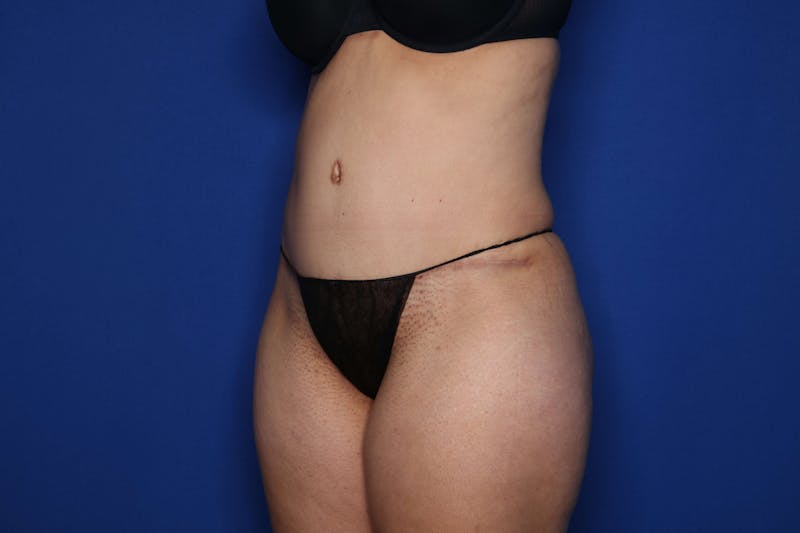 Tummy Tuck Before & After Gallery - Patient 422708 - Image 4