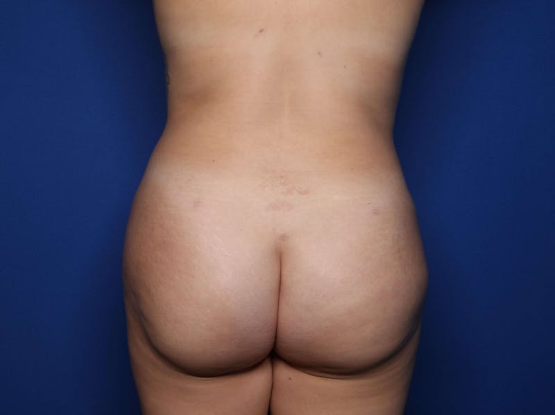 Brazilian Butt Lift Before & After Gallery - Patient 203945 - Image 2