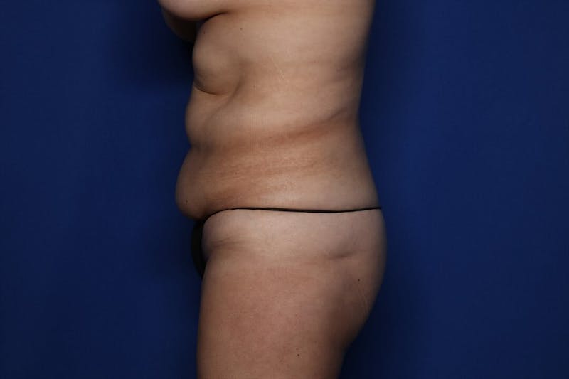 Body Lift Before & After Gallery - Patient 171090 - Image 3