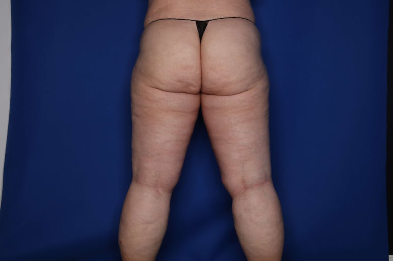 Thigh Lift Before & After Gallery - Patient 307919 - Image 4