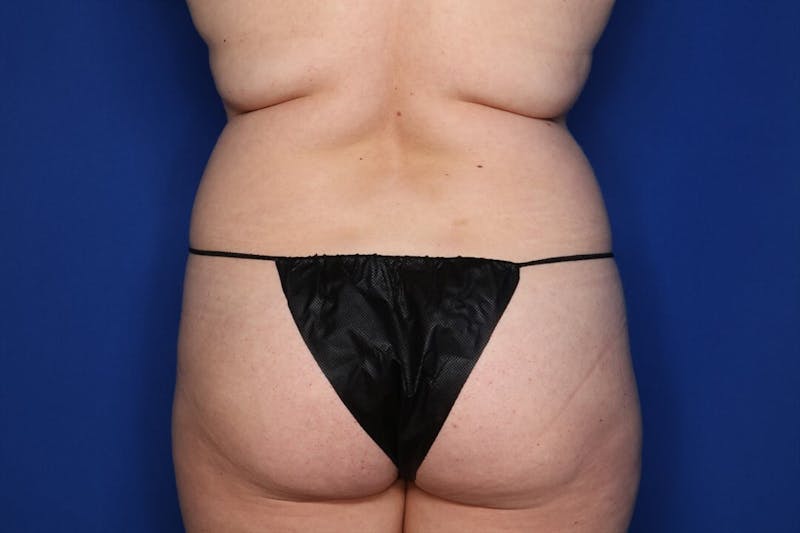 BodyTite™ Before & After Gallery - Patient 397454 - Image 3
