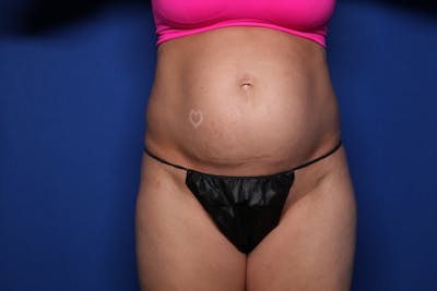 Tummy Tuck Before & After Gallery - Patient 271711 - Image 1