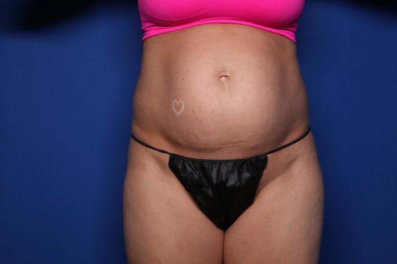 Tummy Tuck Before & After Gallery - Patient 271711 - Image 1