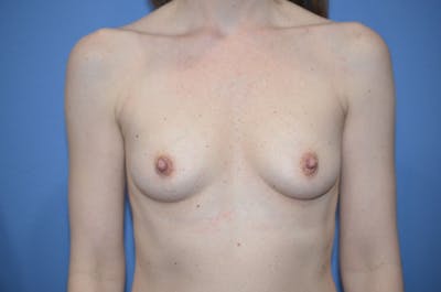 Breast Augmentation Before & After Gallery - Patient 377380 - Image 1